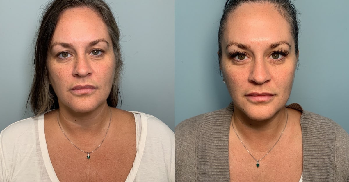 PRF nad Microneedling Before and After