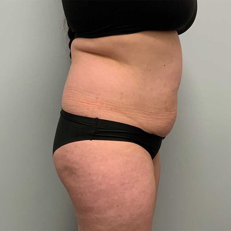 Fat Transfer Before & After Image