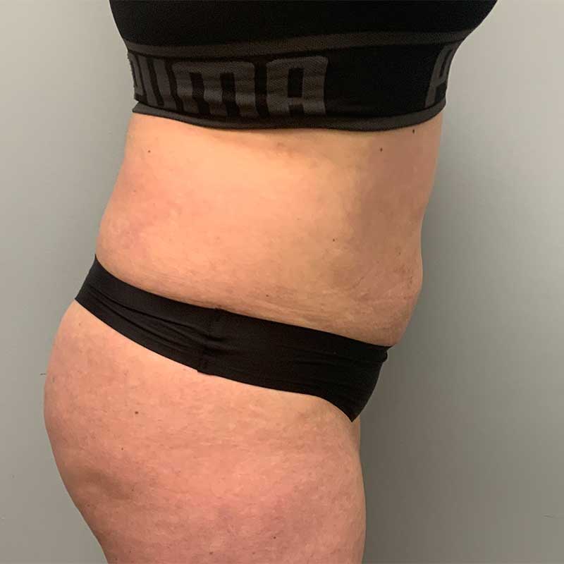 Fat Transfer Before & After Image