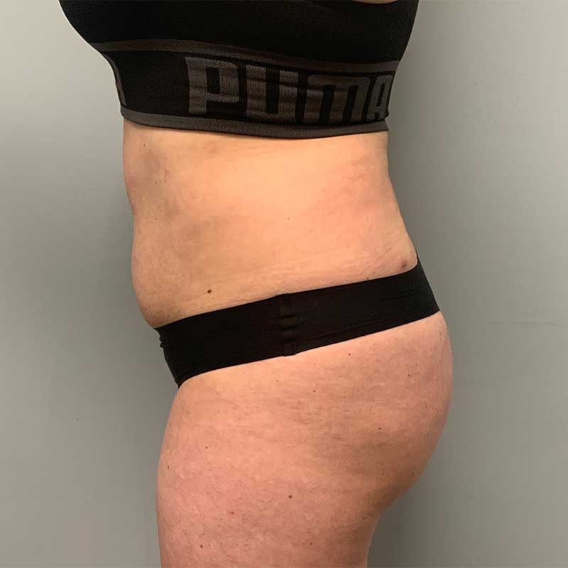 Fat Transfer Before & After Image