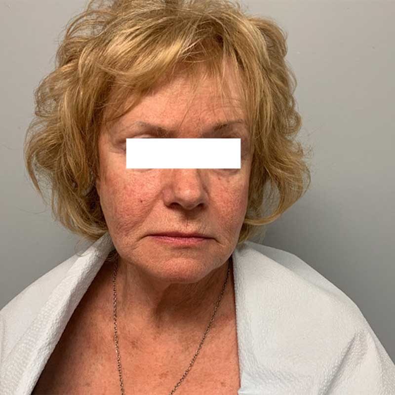 Fat Transfer Before & After Image