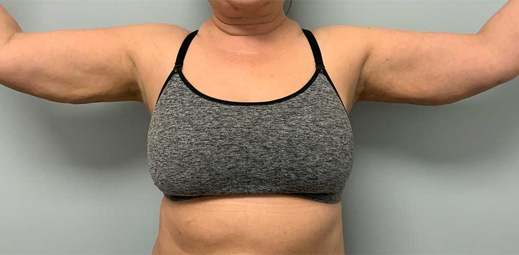 Laser Liposuction BeautiFill Before & After Image