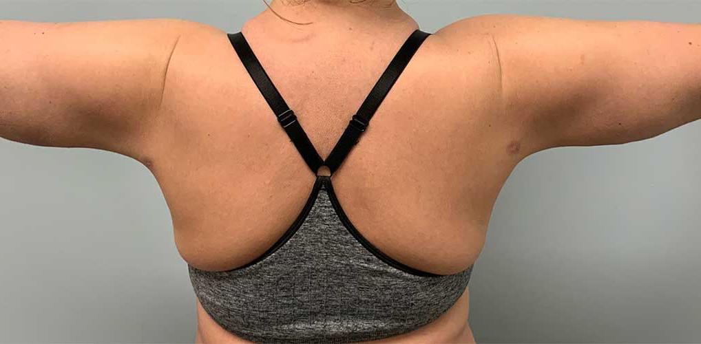 Laser Liposuction BeautiFill Before & After Image