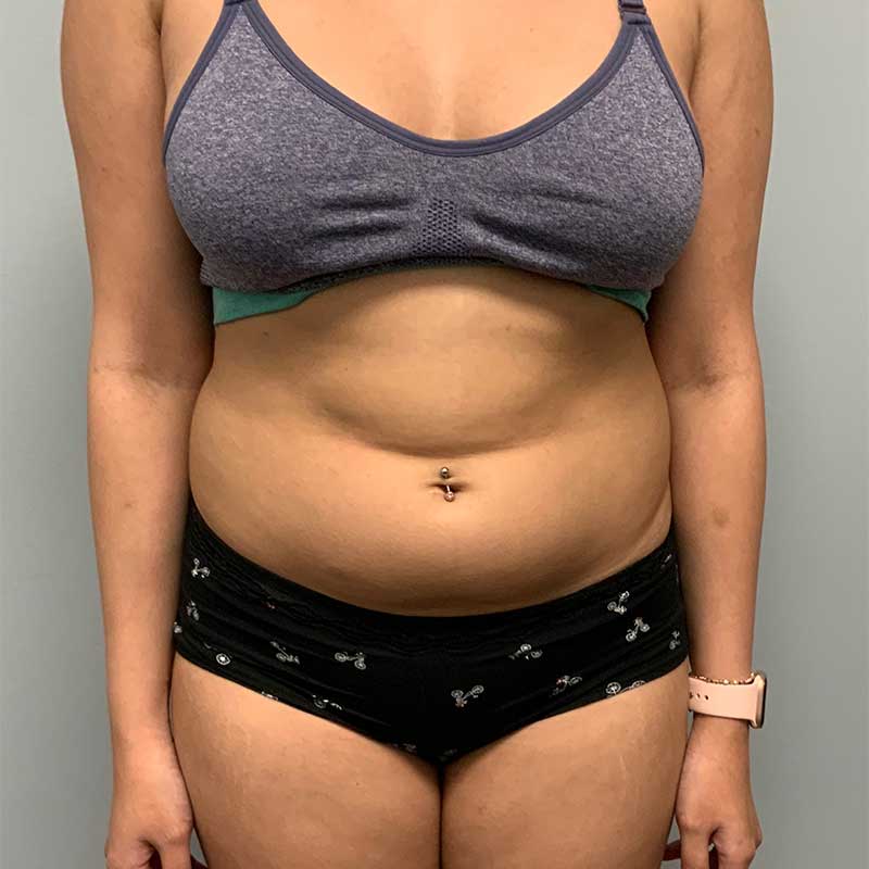 Laser Liposuction BeautiFill Before & After Image