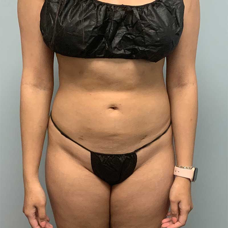 Laser Liposuction BeautiFill Before & After Image