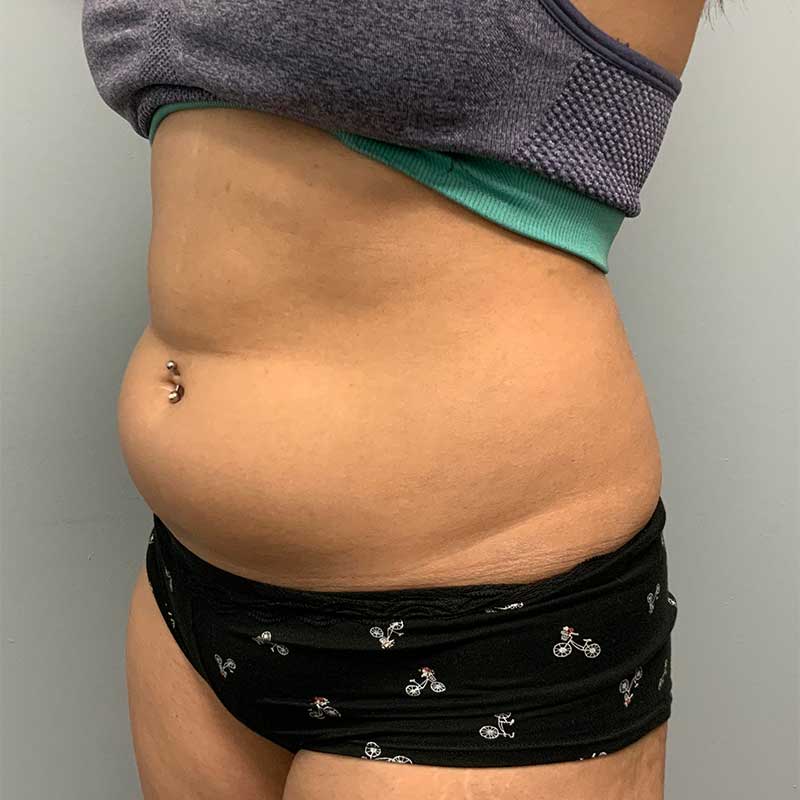 Laser Liposuction BeautiFill Before & After Image