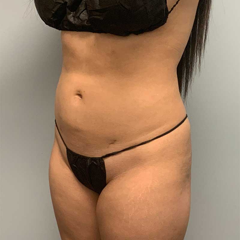 Laser Liposuction BeautiFill Before & After Image