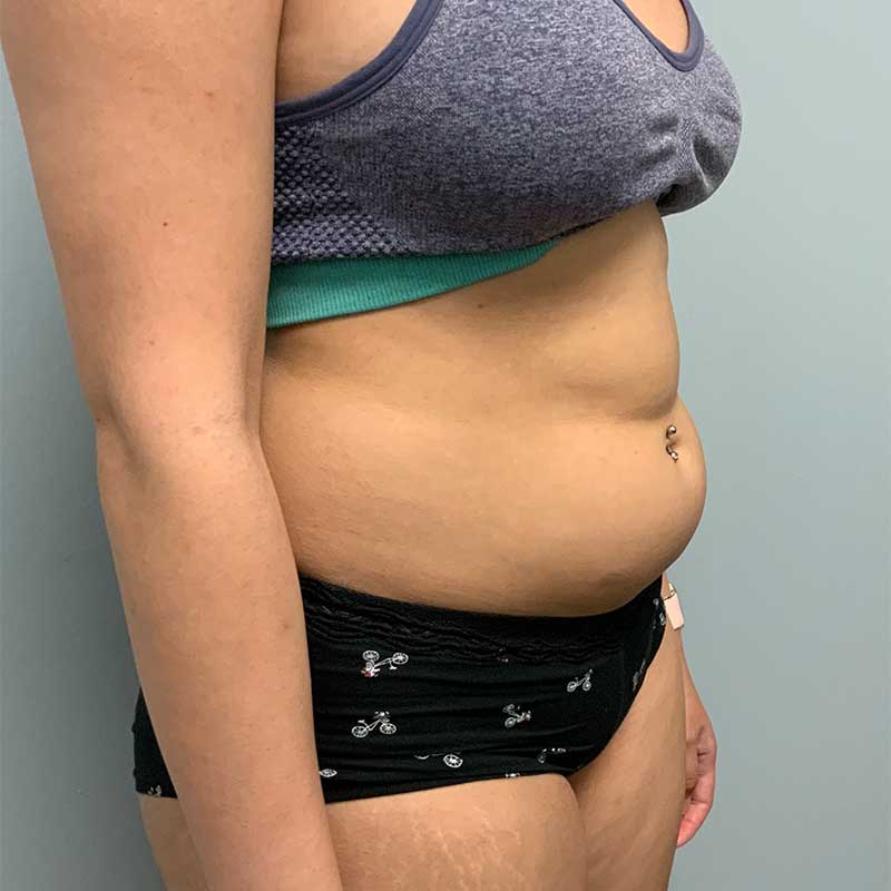 Laser Liposuction BeautiFill Before & After Image