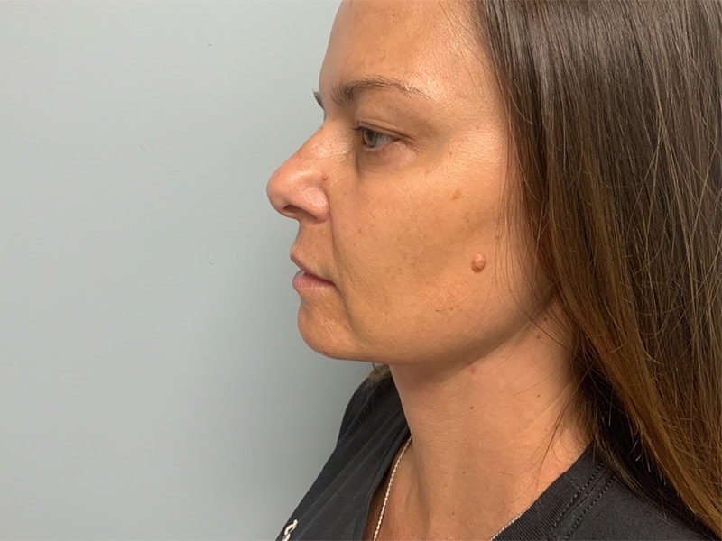 Laser Liposuction BeautiFill Before & After Image