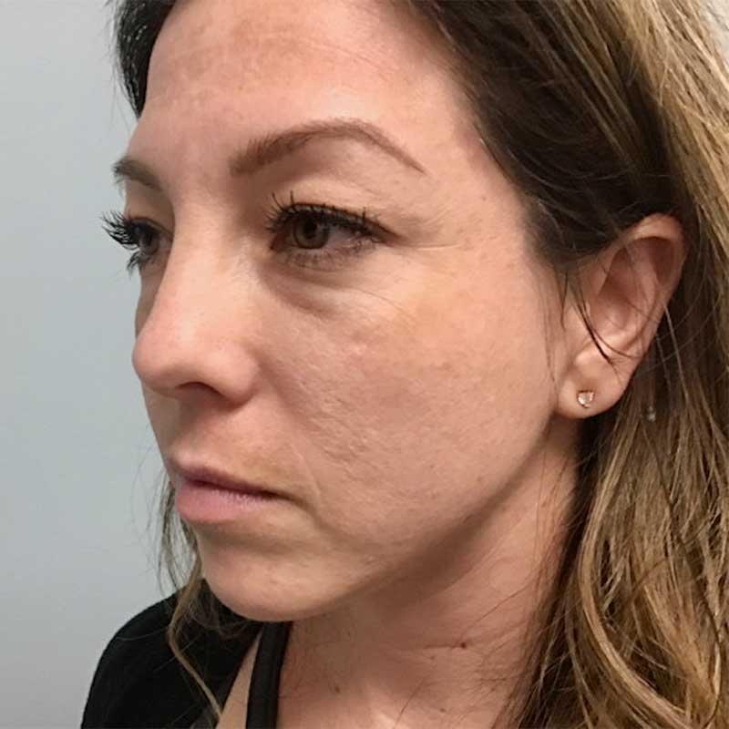 Cheek Fillers Before & After Image