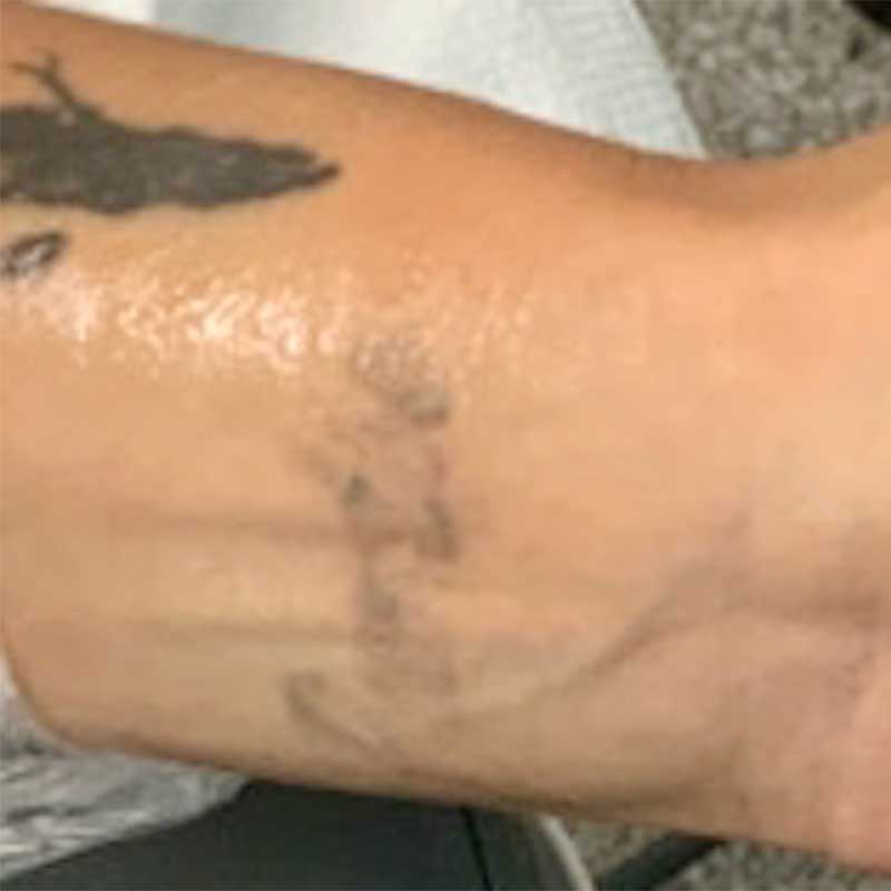 Tattoo Removal Before & After Image