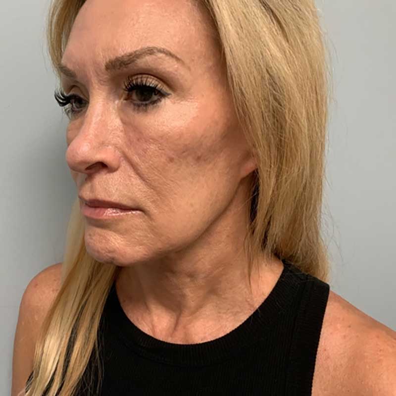 Ultherapy Before & After Image