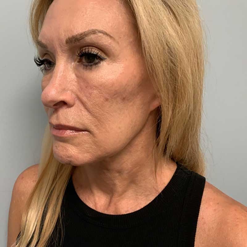 Ultherapy Before & After Image