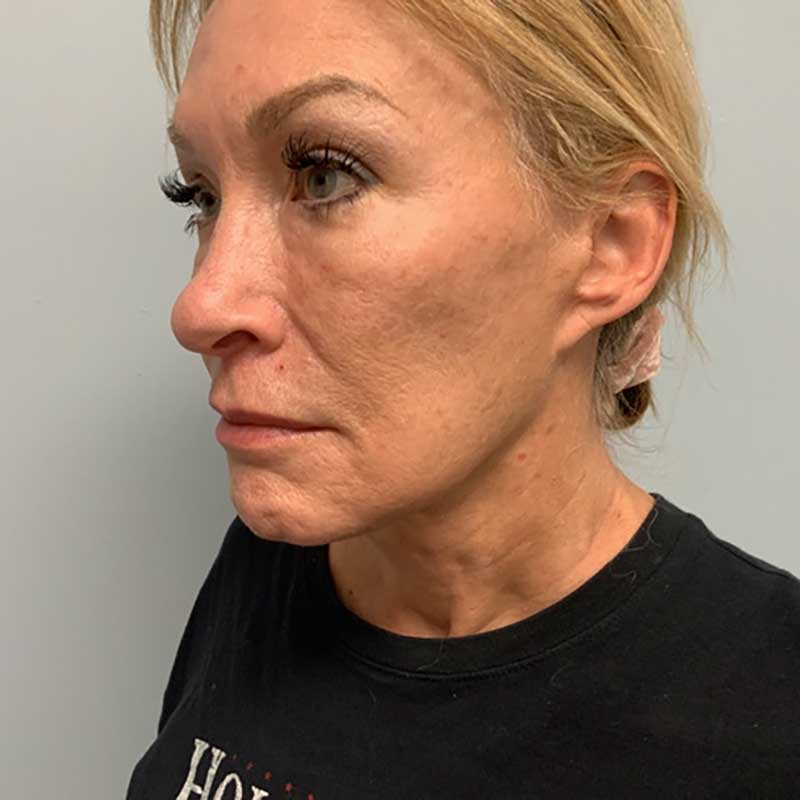 Ultherapy Before & After Image