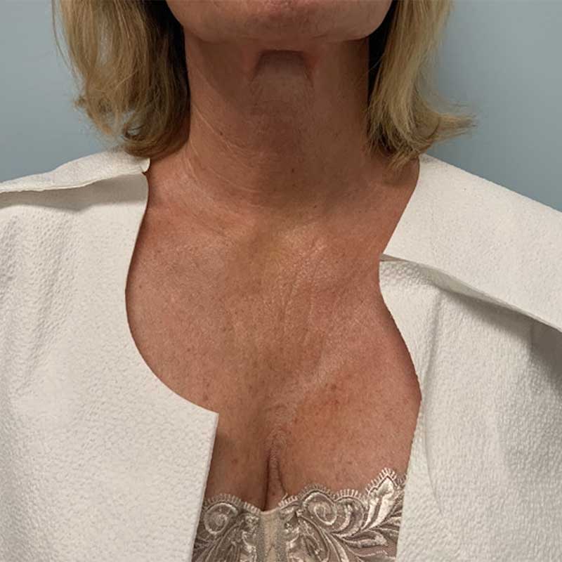 Ultherapy Before & After Image