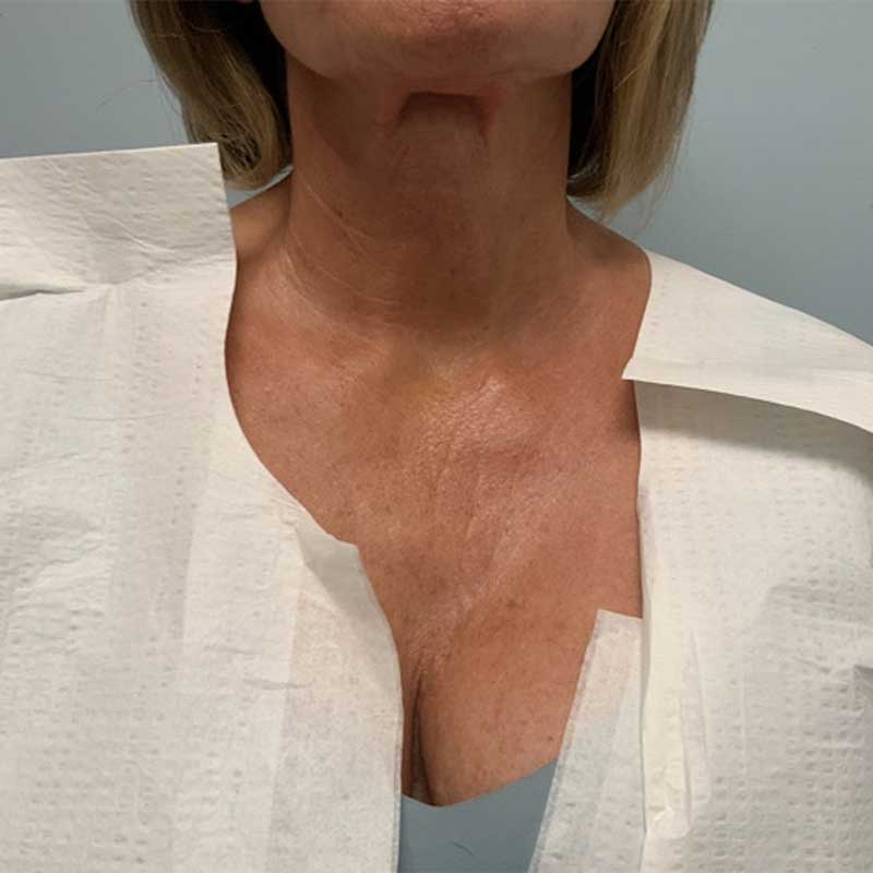 Ultherapy Before & After Image