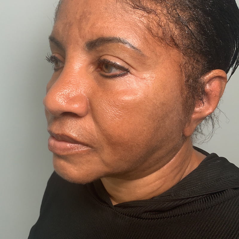 Ultherapy Before & After Image