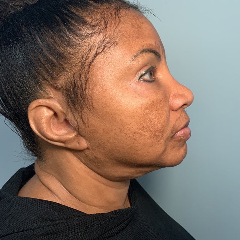 Ultherapy Before & After Image