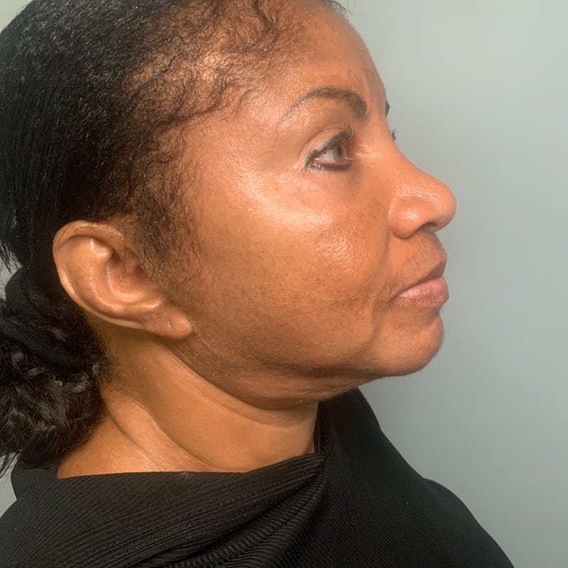 Ultherapy Before & After Image